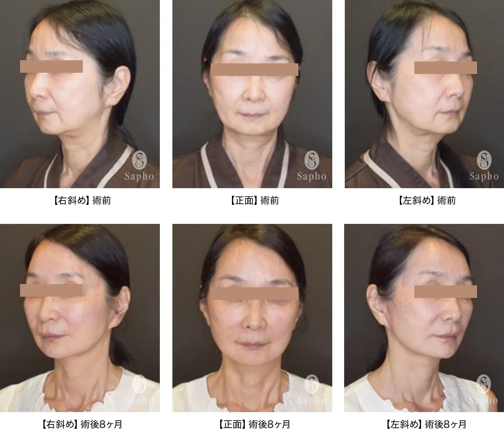 サフォクリニックアングルフェイスリフト症例画像