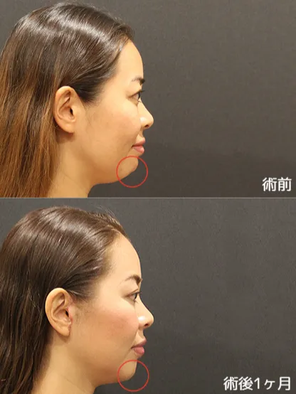 サフォクリニックミニリフト症例