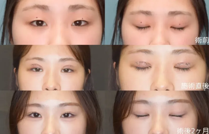 白壁式ビーズ法