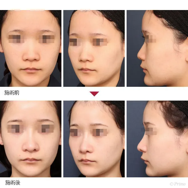 GS 鼻中隔延長術＋他院鼻プロテーゼ入れ替え術＋眉間プロテーゼ（特別注文プロテーゼ）症例