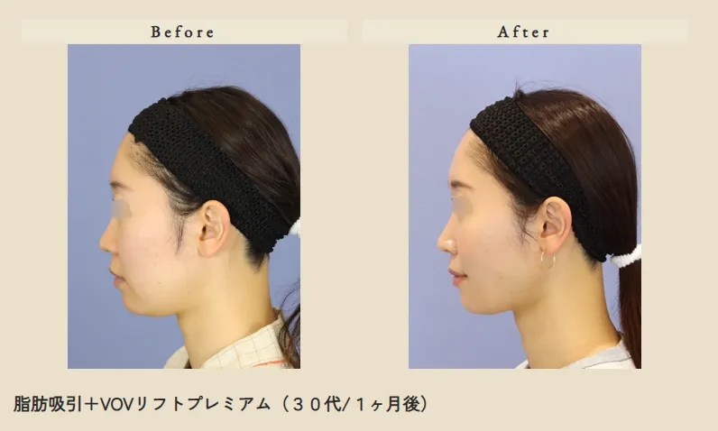 フェイスリフト症例