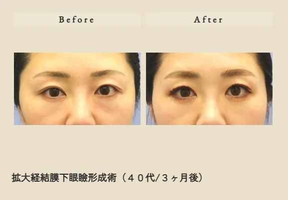 拡大経結膜下眼瞼形成術（フリーファット法）