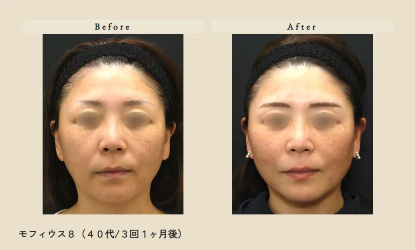 モフィウス８例