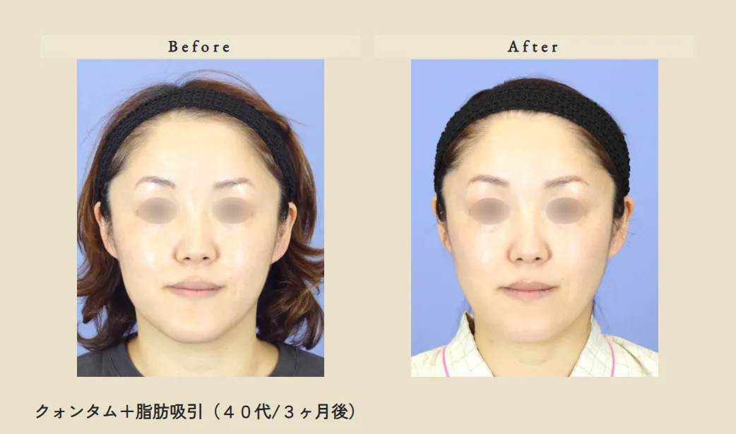 クォンタム症例