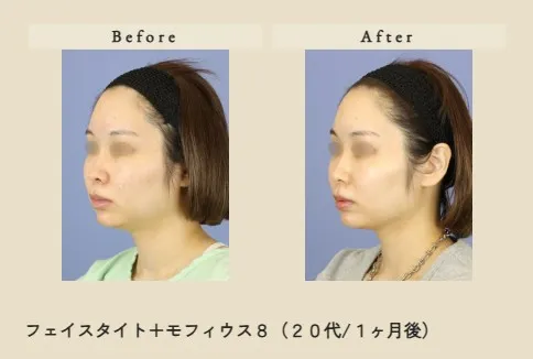 フェイスタイト＋モフィウス８