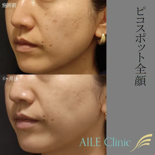 ピコスポット症例