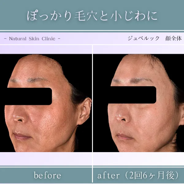 ジュベルック症例