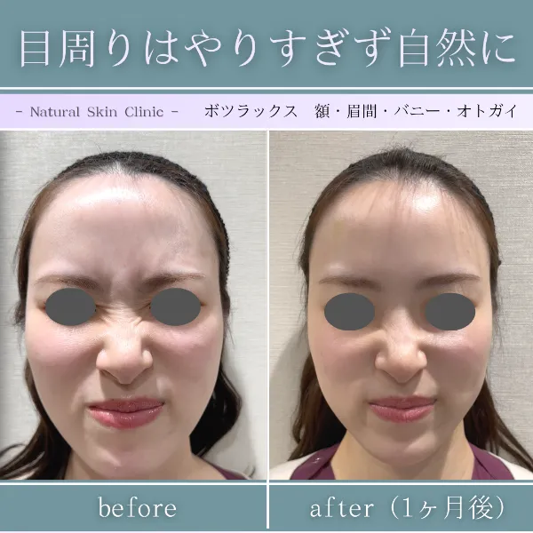 ボトックス症例