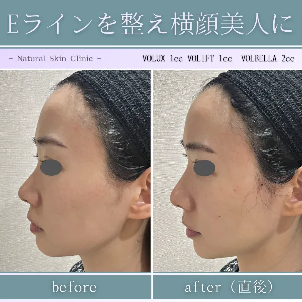 ヒアルロン酸症例