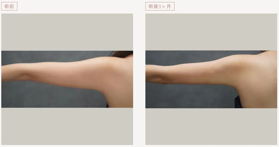 脂肪吸引の症例写真