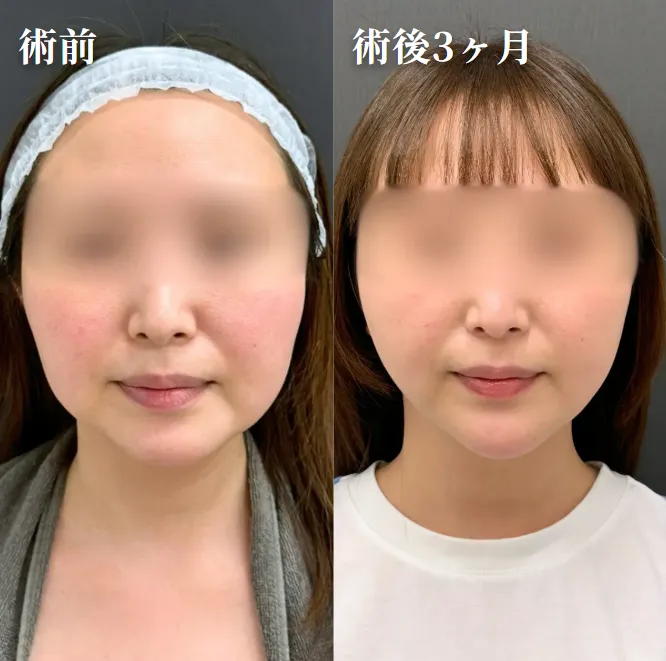 糸リフト症例写真